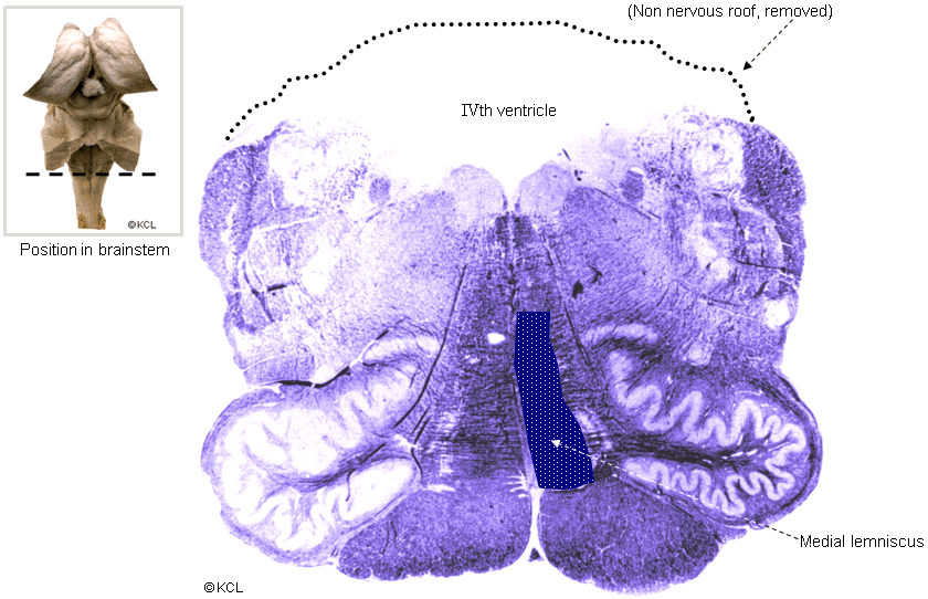 section 5: open medulla, level of inferior olive: medial lemniscus