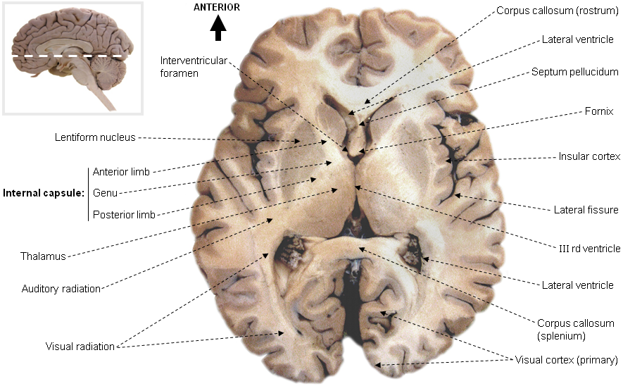 Thalamus - labelled horizontal brain section