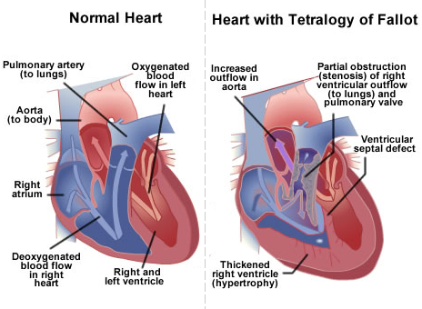 Tetralogy of Fallot