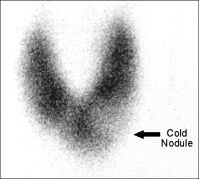 99m Tc Scan with 20min uptake graph large image