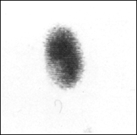 Image B: 99m Tc Thyroid scan with toxic nodule in right lobe and complete supression of left lobe
