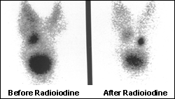 Toxic multinodular goitre with retrosternal extension