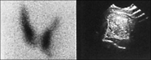 Image B: 99m Tc Thyroid scan: Non functioning cold nodule large image