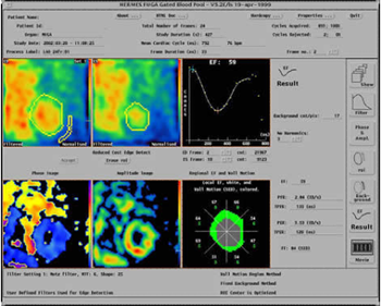 Ejection fraction result together with phase and amplitude images