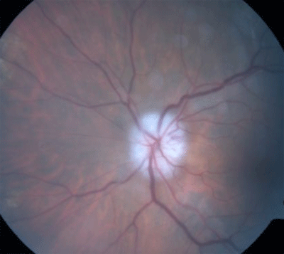 Swollen optic disc