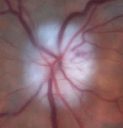 optic disc swelling