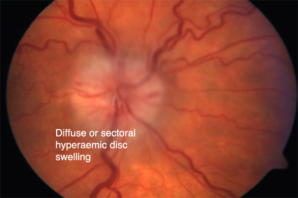 Ischemic optic neuropathy