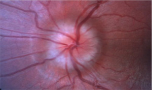 Optic disc drusen