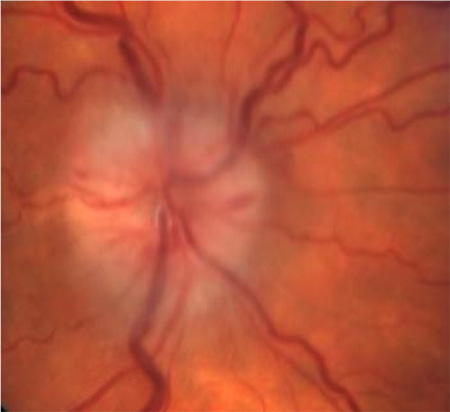 pale swollen optic disc