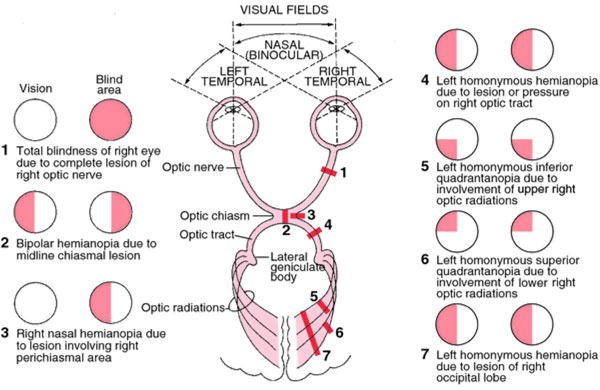 Visual field defects