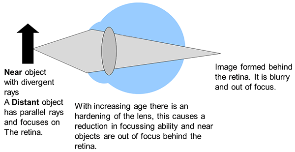 presbyopia