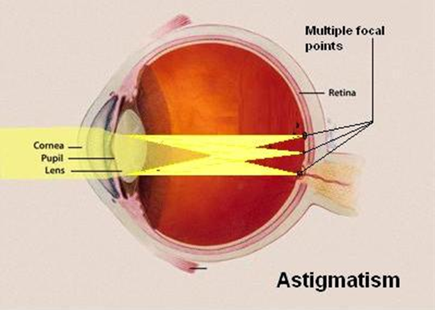 astigmatism