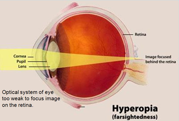 hypermetropia