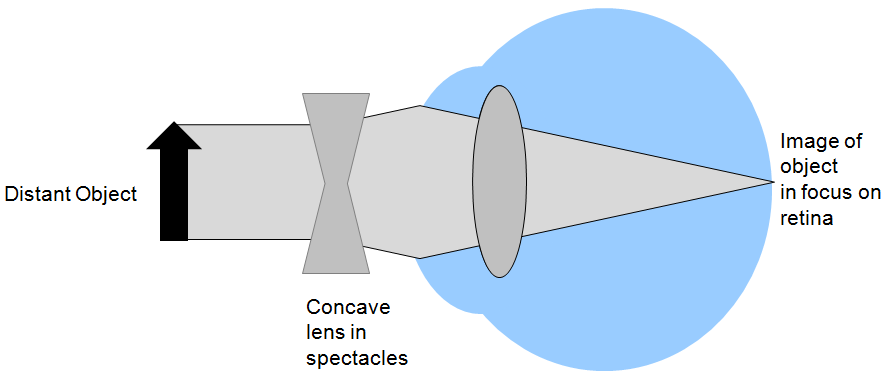 myopia correction