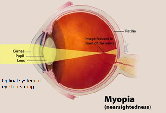 myopia