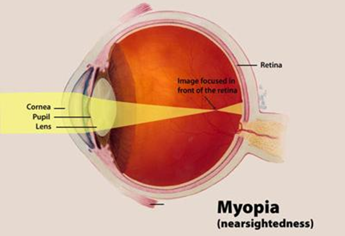 myopia