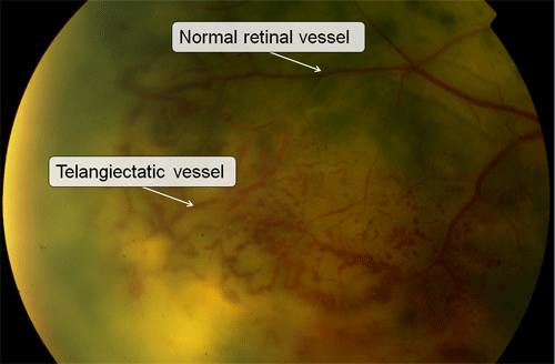 Example of Coats disease