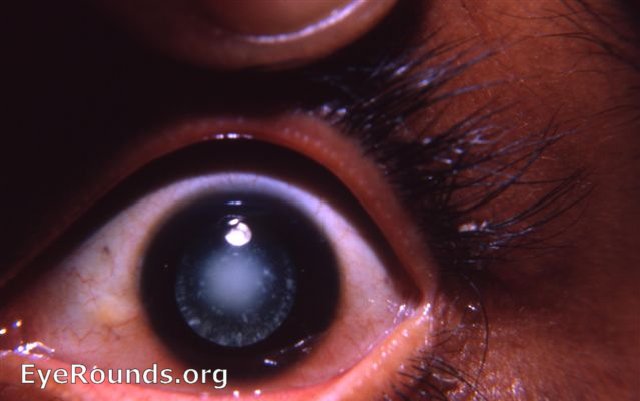 snowflake cataract / leucocoria