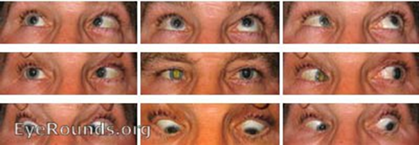 Example of left esotropia