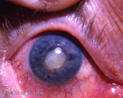 Eye with Uveitis