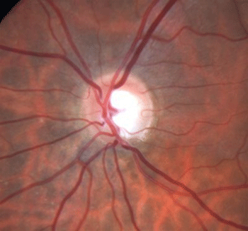 Primary open angle glaucoma (POAG)