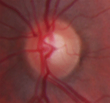 healthy optic nerve