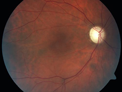 optic atrophy