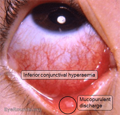 bacterial conjunctivitis