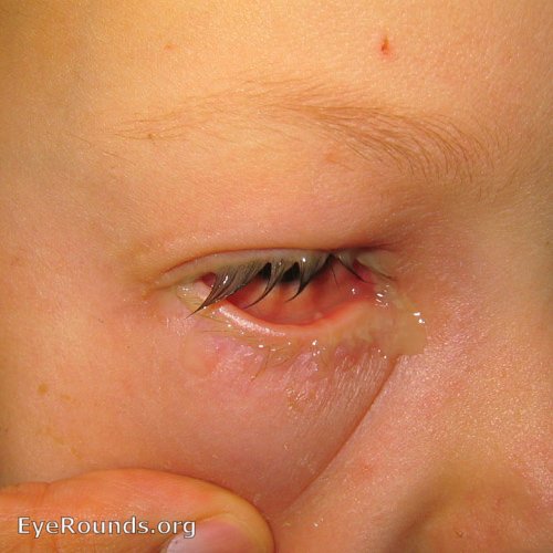 bacterial conjunctivitis