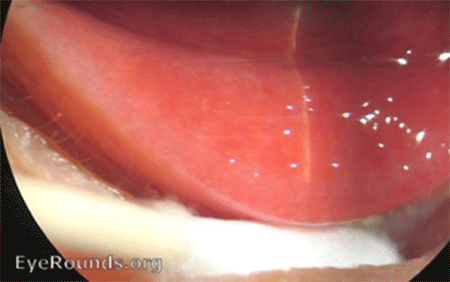 chlamydial conjunctivitis