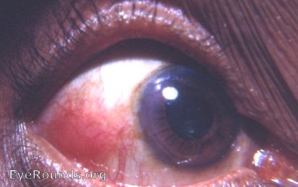 episcleritis