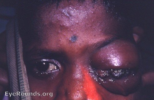 Orbital Cellulitis