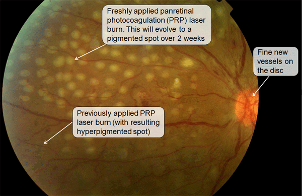 Panretinal Photocoagulation