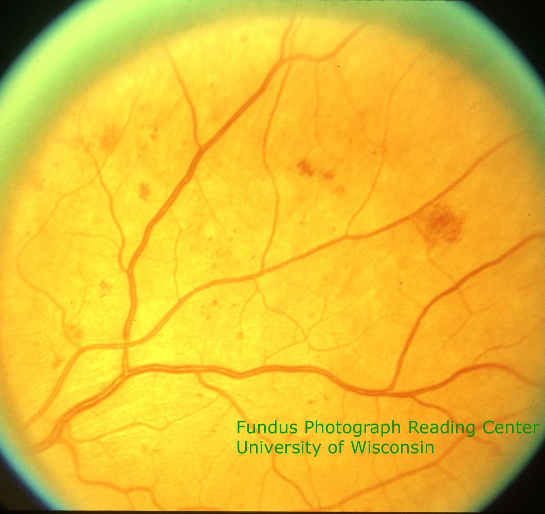 Early Treatment Diabetic Retinopathy Study (ETDRS) standard photograph