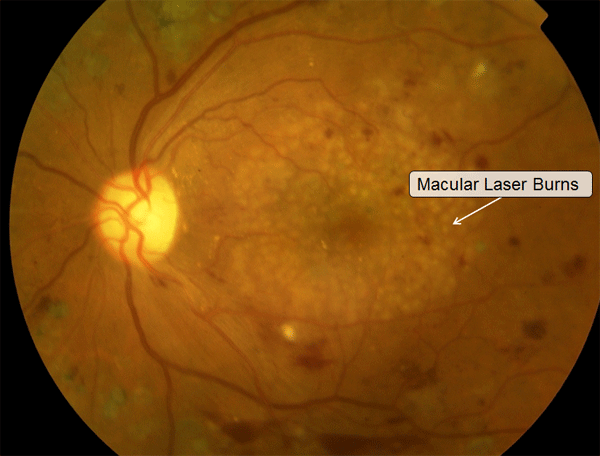 Macular Laser Burns