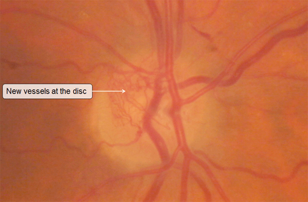 neovascularisation