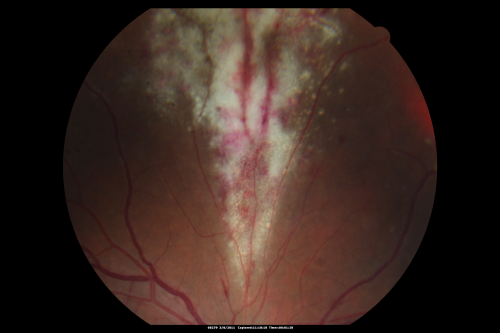 CMV retinitis