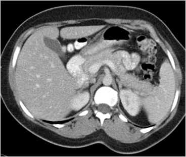 abdominal and pelvis ct