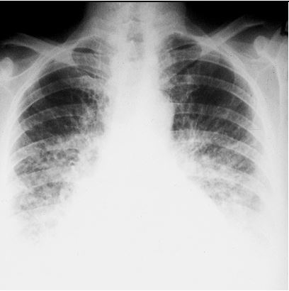 Chest X-ray