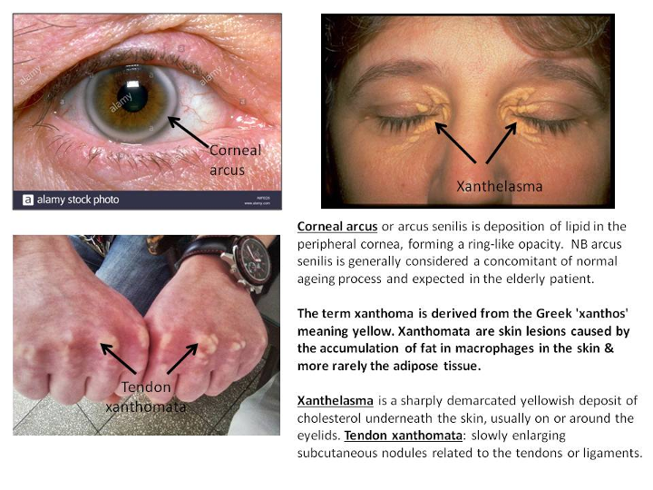 Images of tendon xanthomata etc