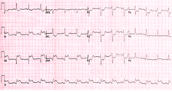 ECG chart