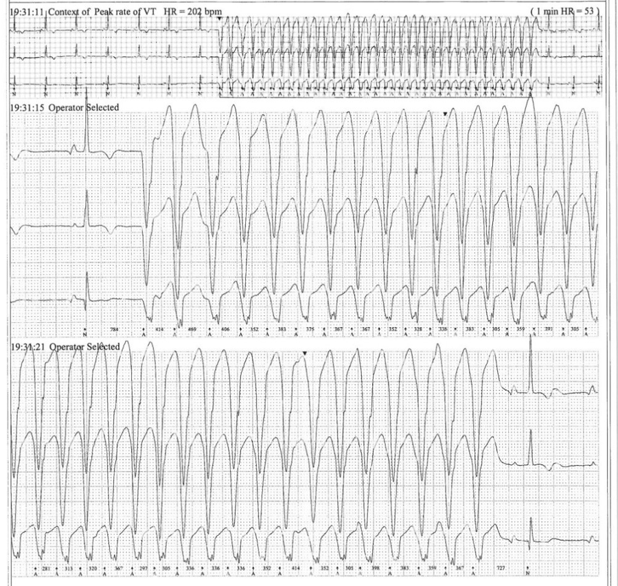 Holter monitor results