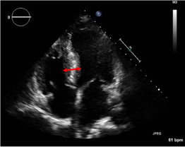 Echocardiogram image