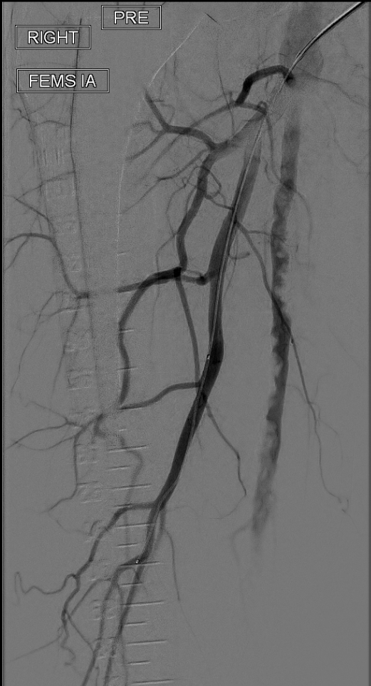 angiogram 1