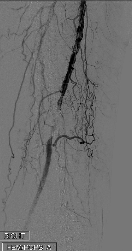 angiogram 2