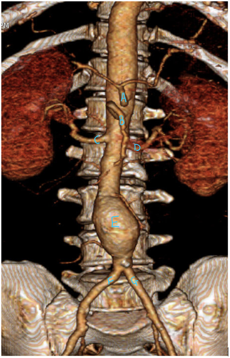 CT image of AAA