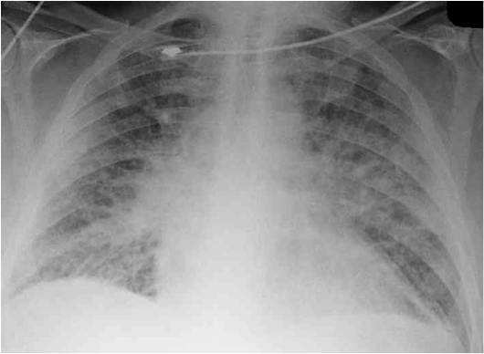 Chest X-ray