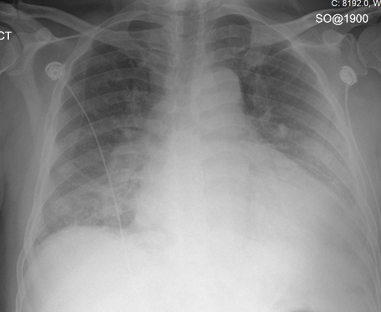 CXR image