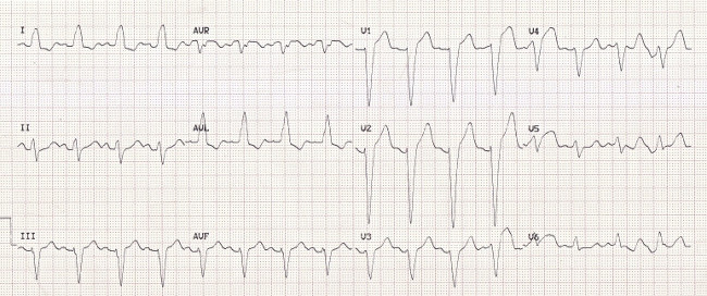 ECG chart with sinus rhythm