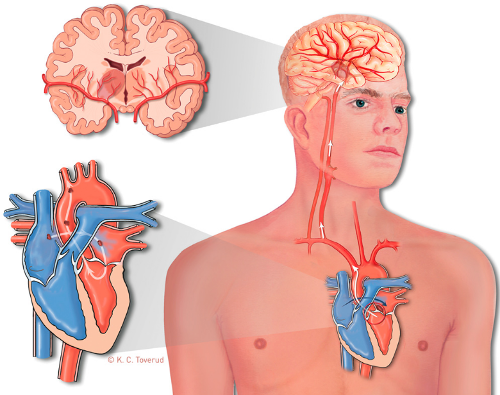 PFO Image